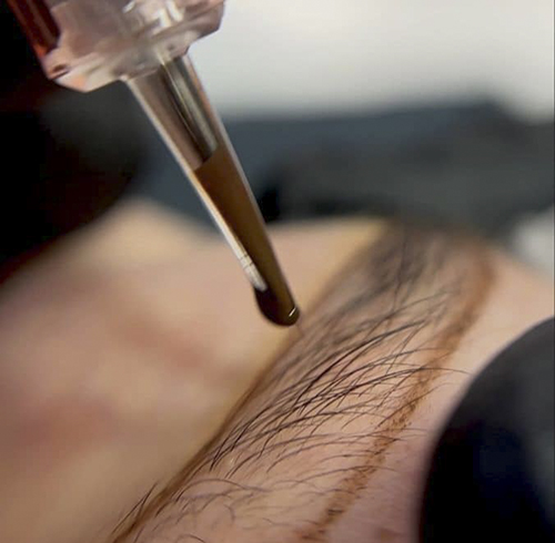 چرا برخی از افراد پس از میکروپیگمنتیشن دچار تغییر رنگدانه می‌شوند؟