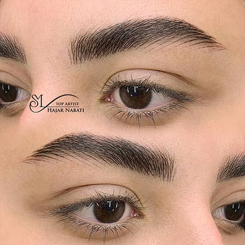 میکروپیگمنتیشن - کد ۱۰۵