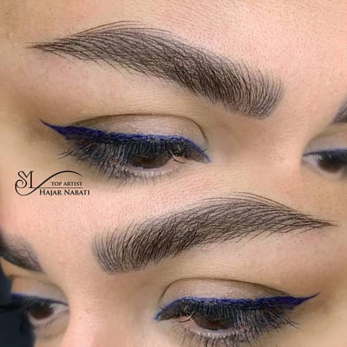 میکروپیگمنتیشن - کد ۱۰۵