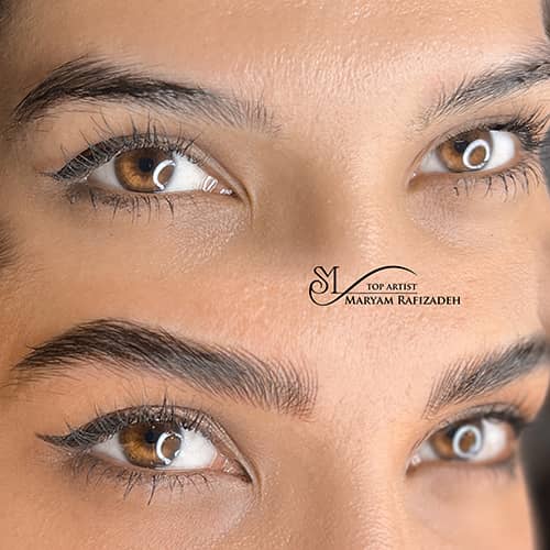 میکروپیگمنتیشن - کد ۱۰۶