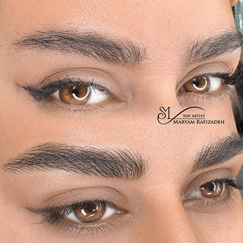 میکروپیگمنتیشن - کد ۱۰۶