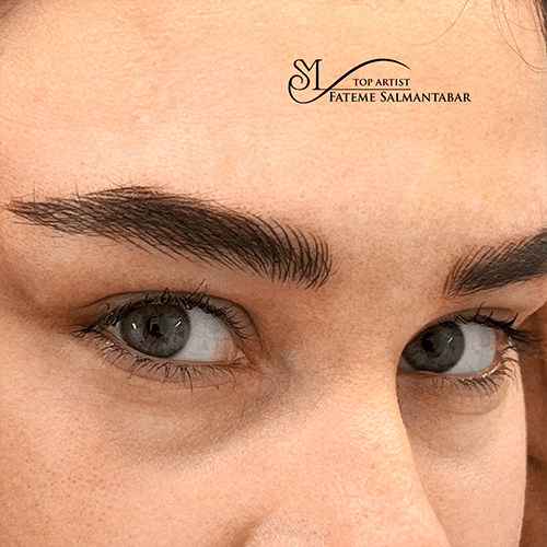 میکروپیگمنتیشن - کد ۱۰۷