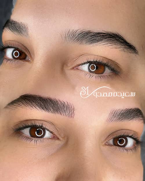 میکروبلیدینگ - ۱۰۳