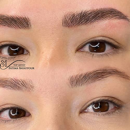 میکروپیگمنتیشن - کد ۱۰۴