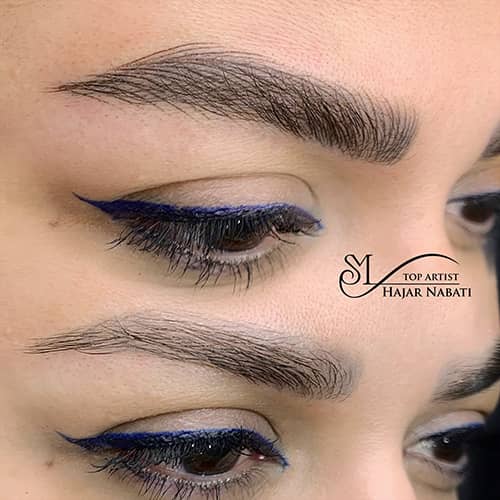 میکروپیگمنتیشن - کد ۱۰۵